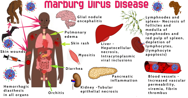 WHO puts Nigeria, others on High Alert as Ghana announces First Marburg Virus Case