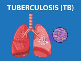 Federal Government Secures N80b Funding to Eliminate Tuberculosis